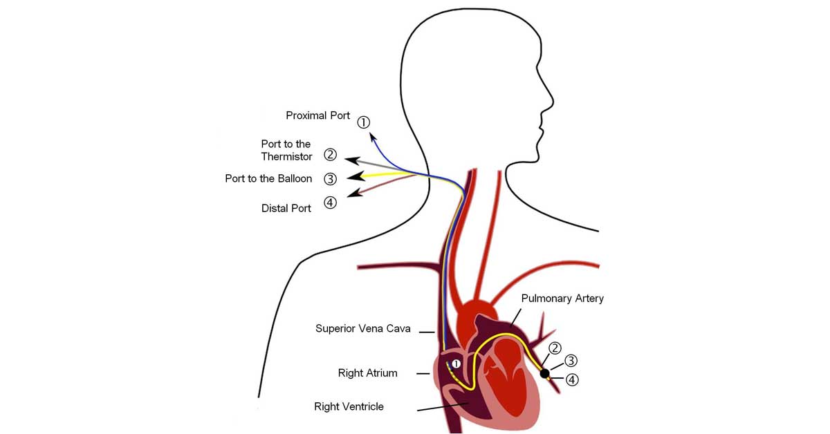 PAWP (Pulmonary Arterial Wedge Pressure) Test