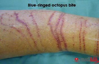 vermoeidheid Malen strottenhoofd Causes of Blue-ringed octopus bite | Asha Didi