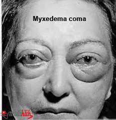 Overview Of Myxedema Coma Asha Didi Overview Of Myxedema Coma Asha Didi