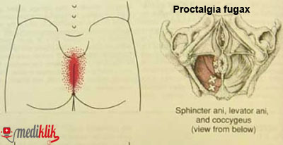 proctalgia