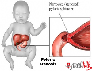 प यल र क स ट न स स क क रण Pyloric Stenosis Ke Karan Causes In Hindi Asha Didi